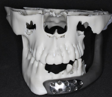 Modelo anatómico frontal con reconstrucción mandibular
