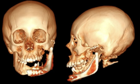 Reconstrucción tridimensional frontal y lateral de la mandíbula