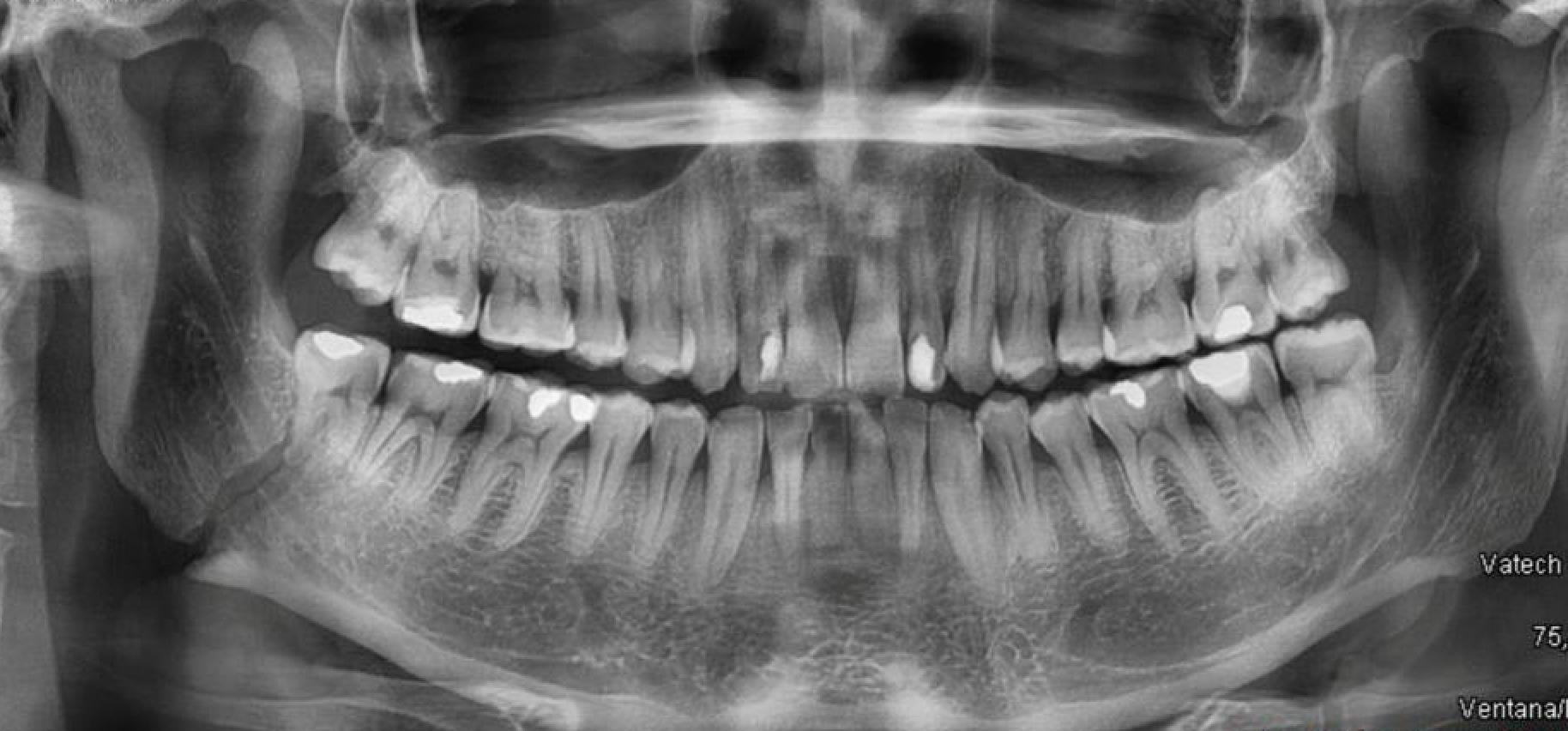 Radiografía panorámica antes de la reducción de fractura del ángulo mandibular