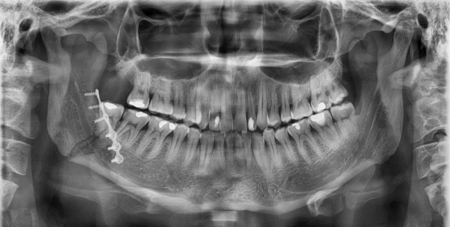 Radiografía panorámica después de la fijación de la fractura del ángulo mandibular