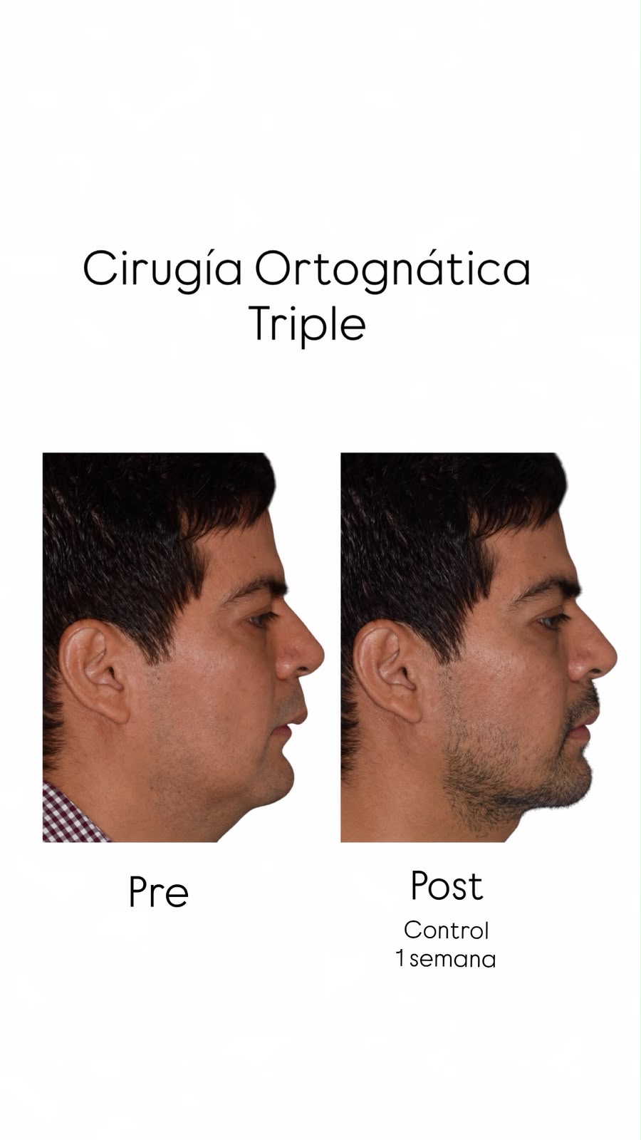 Comparación de perfil antes de cirugía ortognática y en control a la semana