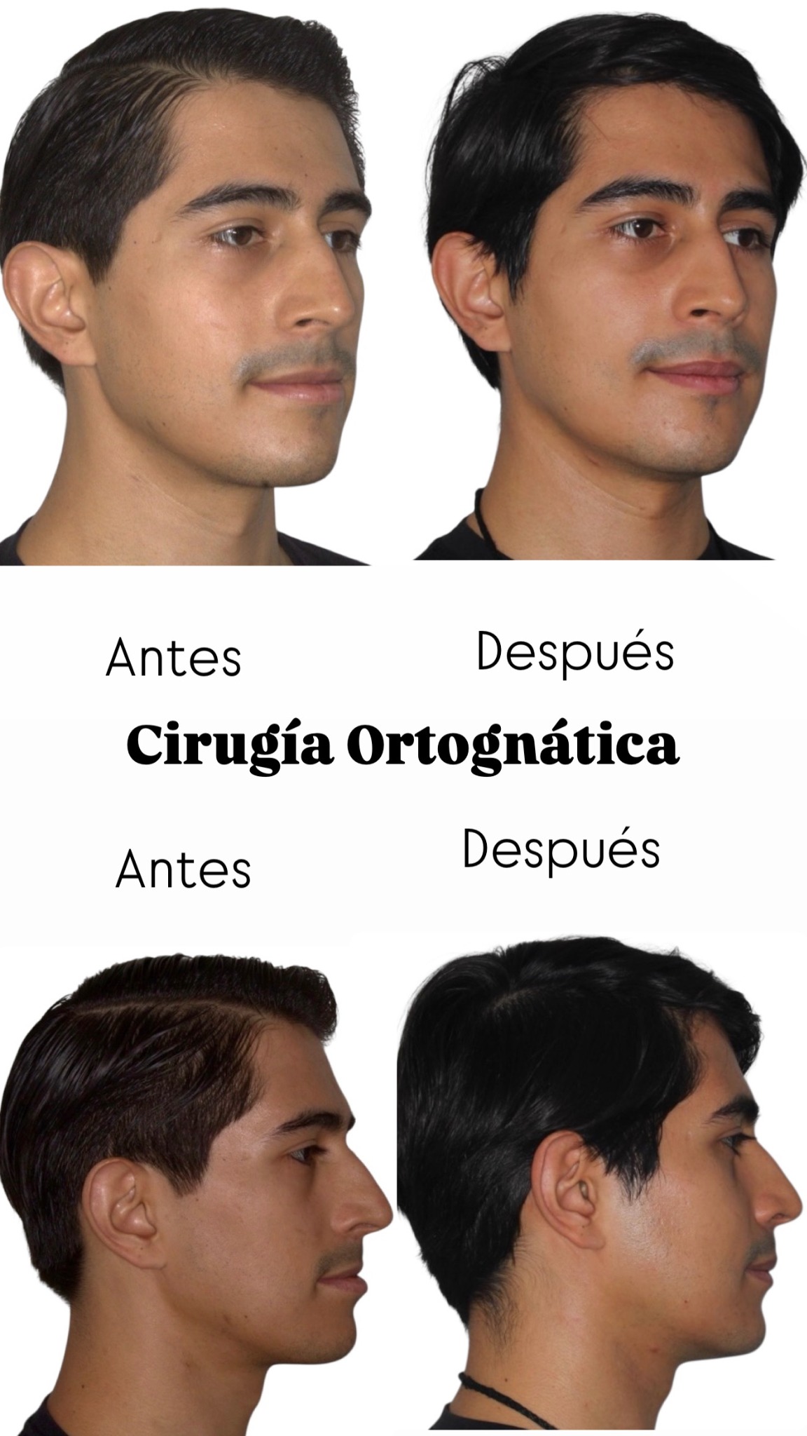Comparativa facial frontal y de perfil antes y después de cirugía ortognática